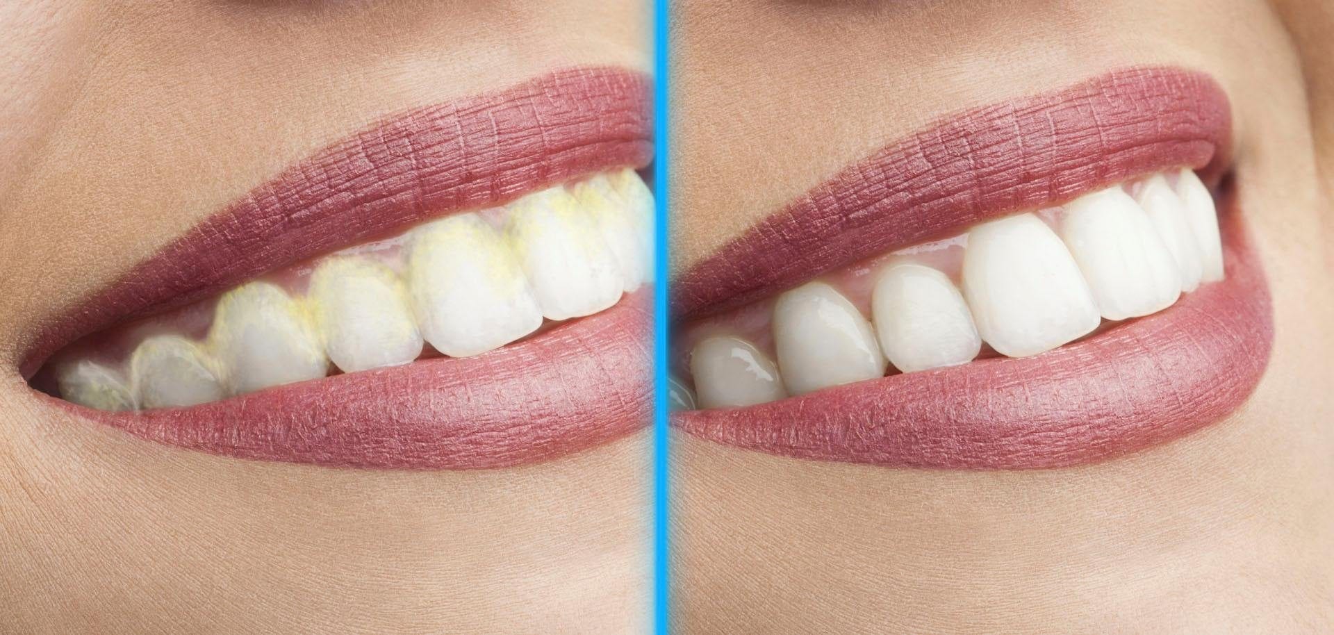 MediaShop Set d'hygiène dentaire »DentaPic Sonic« exklusives Set mit 2 zusätzlichen Aufsätzen