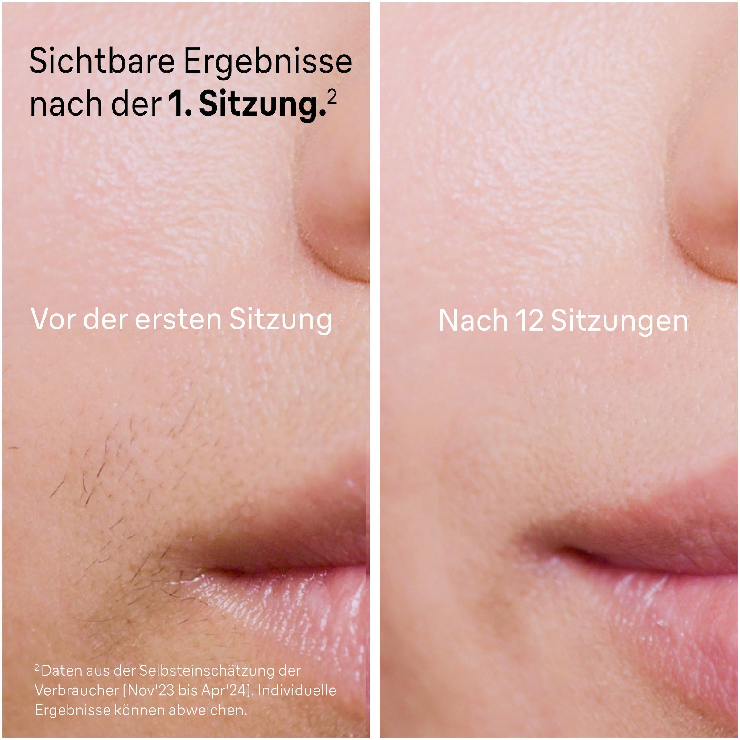 Braun Épilateur IPL »Smart Skin i·expert PL7147« 2 Aufsätze für Gesicht & Körper, Venus Rasierer & Aufbewahrungstasche
