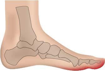 Fussgut Überbeinschutz »Hallux Schutz mit Gelpolster«, Druckentlastung bei Hallux Valgus, Hallux Valgus Bandage