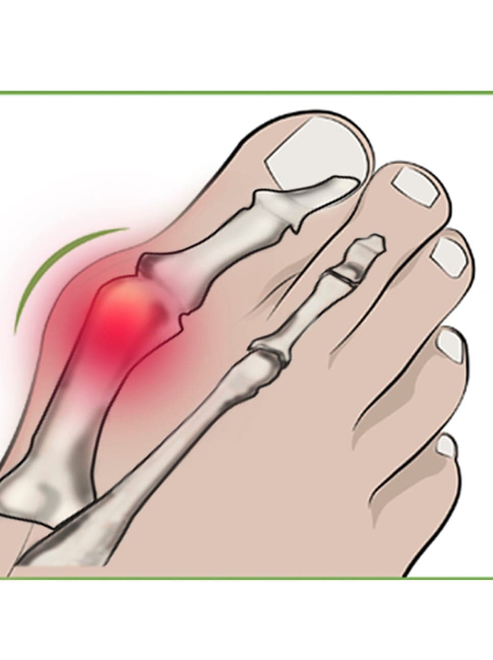   Hallux-Bandage