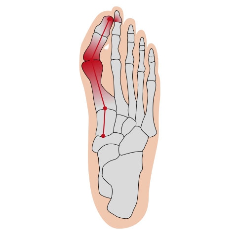 Fussgut Hallux-Bandage »Softkissen«