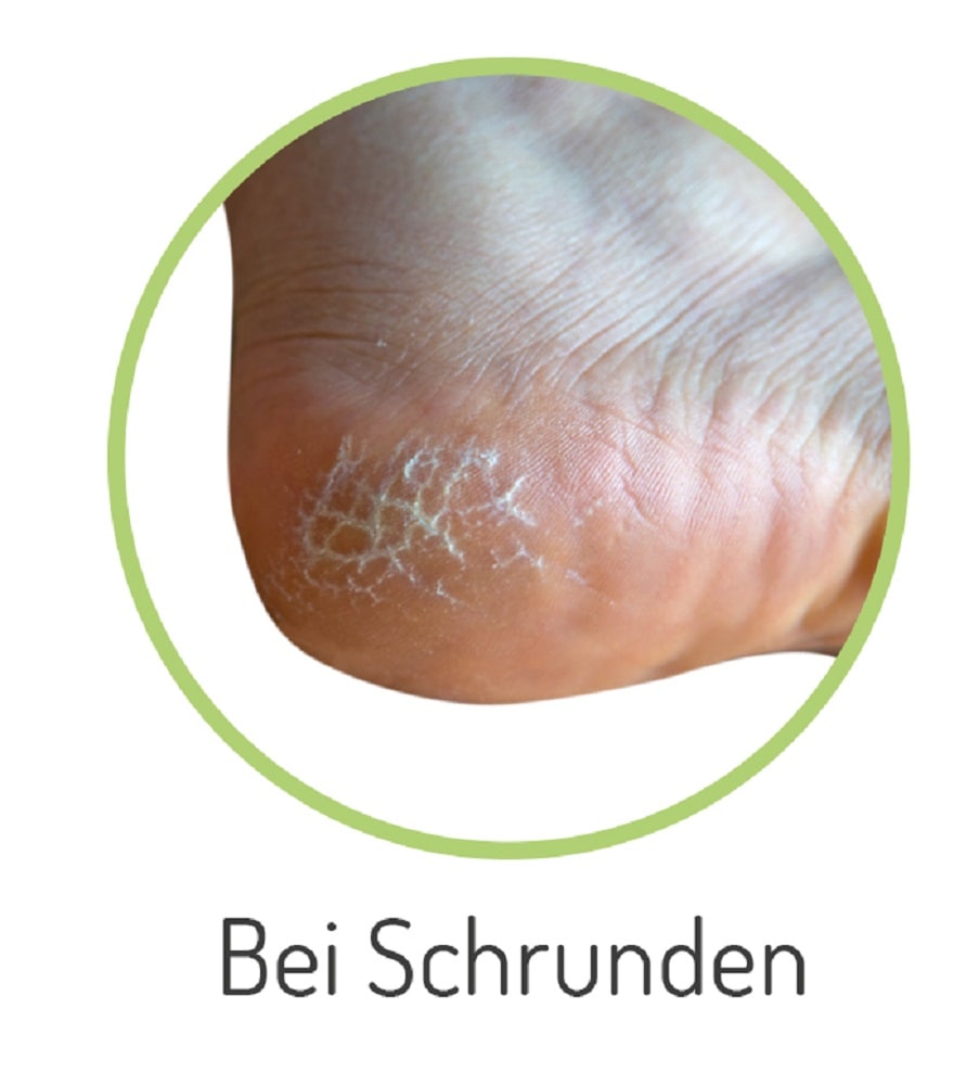 Fussgut Hallux-Bandage »"Individual" mit softem Gel-Ballenpolster, einfach anzulegen«, angenehmer Tragekomfort, individuelle Einstellmöglichkeiten