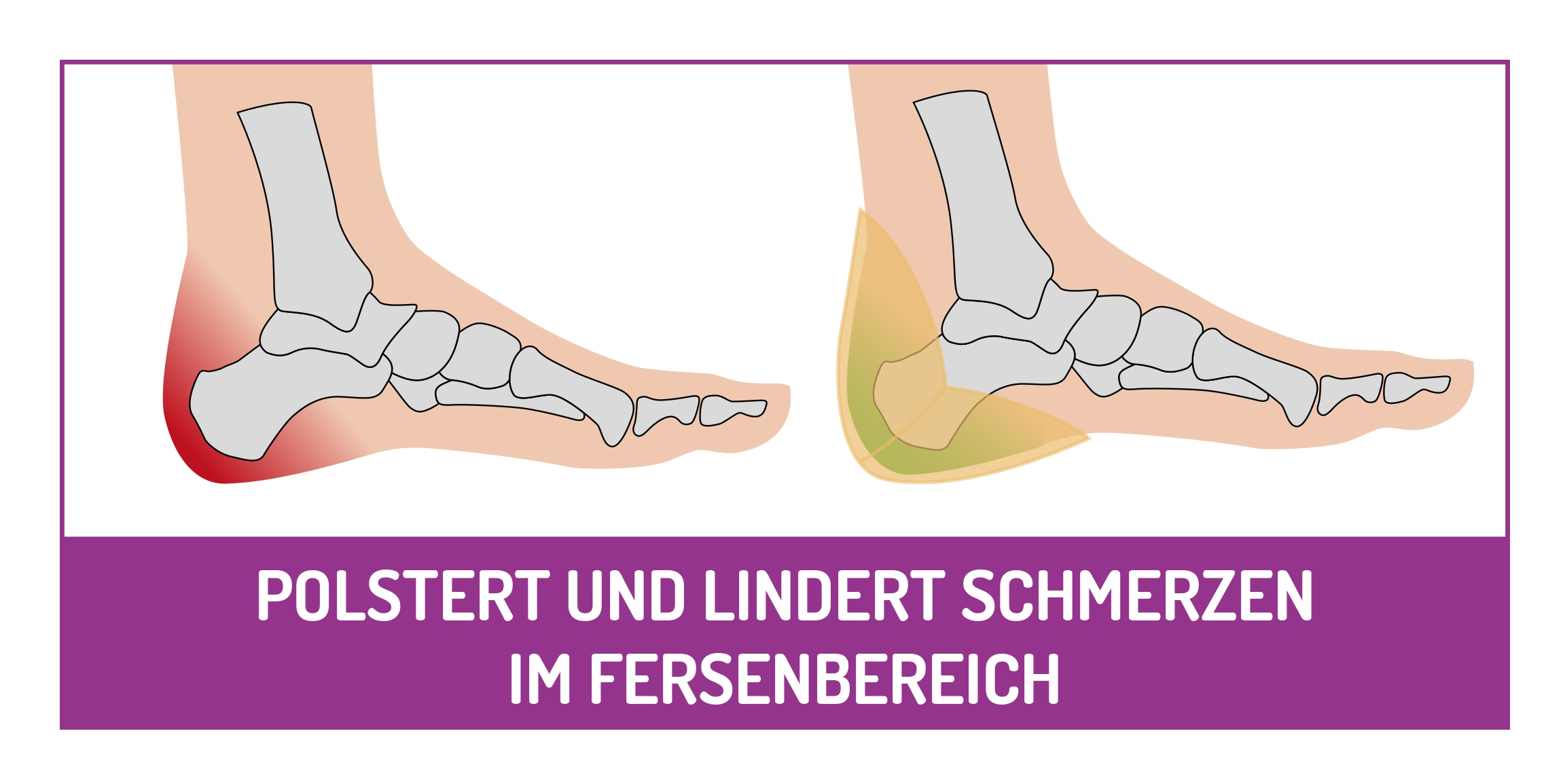 Fussgut Hallux-Bandage »"Individual" mit softem Gel-Ballenpolster, einfach anzulegen«, angenehmer Tragekomfort, individuelle Einstellmöglichkeiten