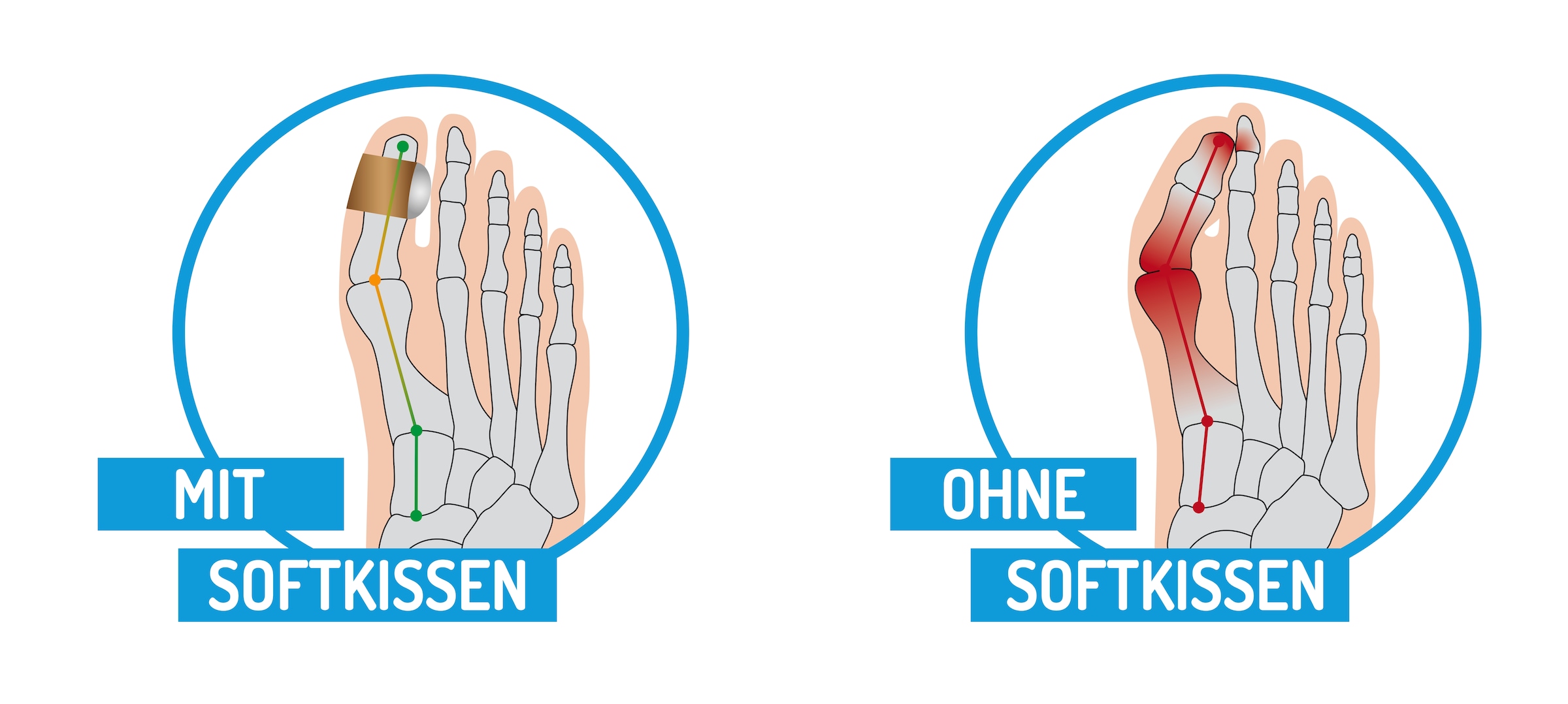 Fussgut Hallux-Bandage »Softkissen mit Fixierband, verhindert Reiben«, Druckentlastung bei Hühneraugen, Schwielen, Entlastung Hallux Valgus
