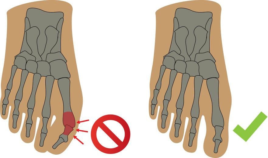 Fussgut Überbeinschutz »Hallux Schutz mit Gelpolster«, Druckentlastung bei Hallux Valgus, Hallux Valgus Bandage
